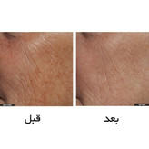 لیزر جوانساز خانگی Tria آمریکا اصلی (پس کرایه)
