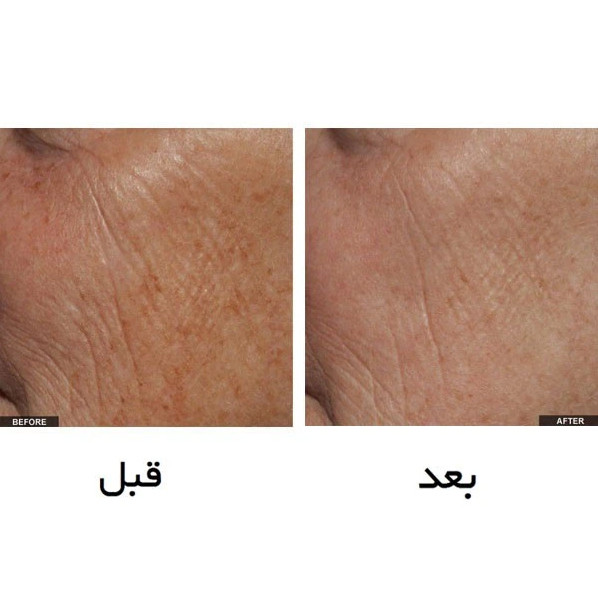 لیزر جوانساز خانگی Tria آمریکا اصلی (پس کرایه)